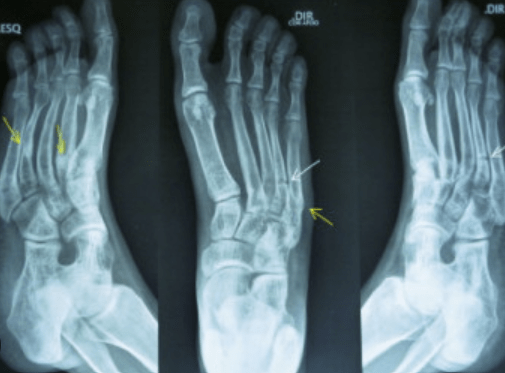 X-RAY PROTOCOLS: xr foot 3v ap/lat/obl ltxr shldr >/=3v ap/tru ap/othr rt