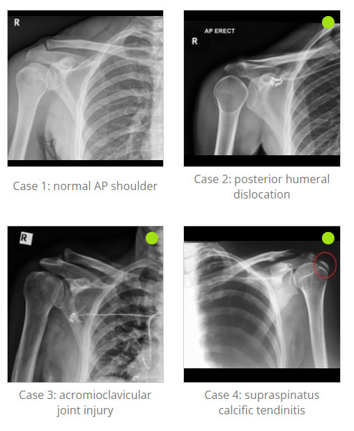 The Shoulder AP View in Radiology: An Essential Projection for Shoulder Evaluation