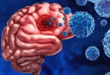 “Groundbreaking Use of Mutation-Specific Peptide Vaccine Against Midline Gliomas in Patients” “Groundbreaking Use of Mutation-Specific Peptide Vaccine Against Midline Gliomas in Patients”
