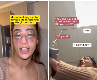 Shocking TikTok Allergic Reaction: Woman’s Close Call with Death Reveals Crucial Lesson