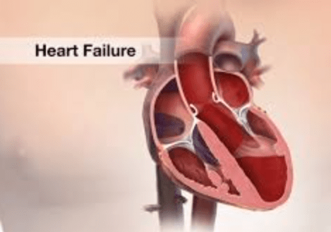 Decoding Heart Failure: Exploring the 4 Types and Their Telltale Signs