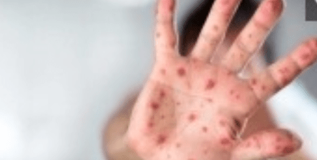 Ontario’s Chief Medical Officer Warns of Potential Measles Outbreaks Amid Global Surge in Infections”